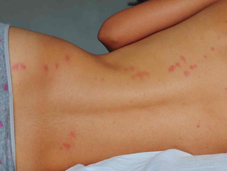 Bettwanzen.jpg | © iStock/Joel Carillet