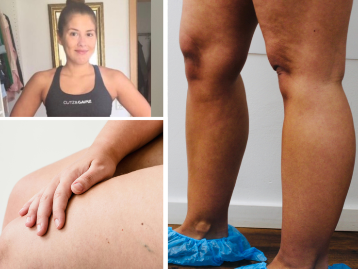 Collage aus drei Bildern: sportliche Frau in Trainingskleidung, Hand auf einem Oberschenkel, Beine mit blauen Einwegüberziehern.