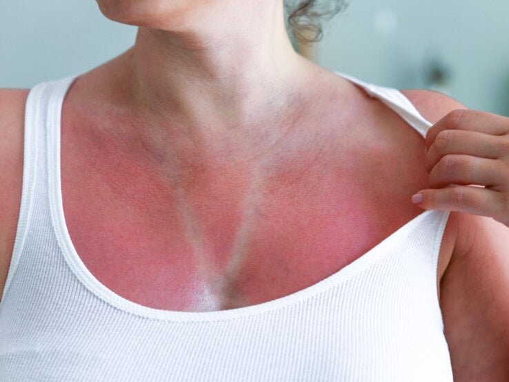Eine Frau mittleren Alters zeigt in weißem Top ihre gerötete Haut mit deutlichem Sonnenbrand und heller Streifenbräune.