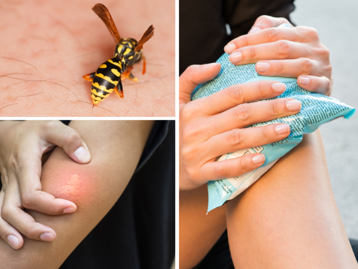 Drei Szenen: Wespenstich auf Haut, gerötete Einstichstelle am Arm und eine Hand, die einen Eisbeutel auflegt.