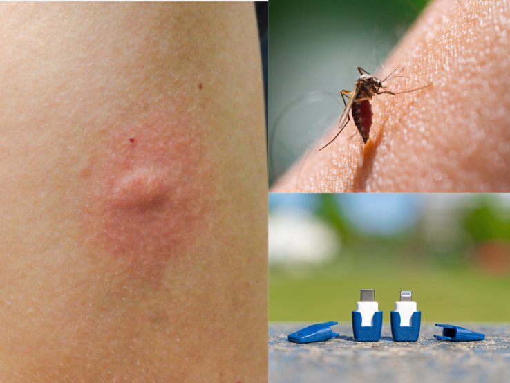 Nahaufnahme einer geschwollenen roten Einstichstelle auf Haut, daneben eine Mücke beim Stechen und ein elektronischer Insektenstichheiler im Freien.
