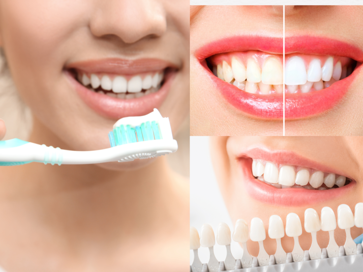 Junge Frau mit makellosem Lächeln hält Zahnbürste vor den Mund, daneben Vorher-nachher-Zähne und Farbskala zur Zahnaufhellung.